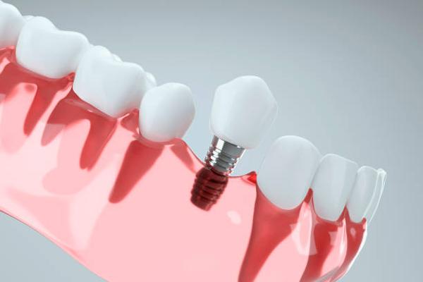 Fort Worth’s Leading Dental Implant Providers: Your Smile Restored